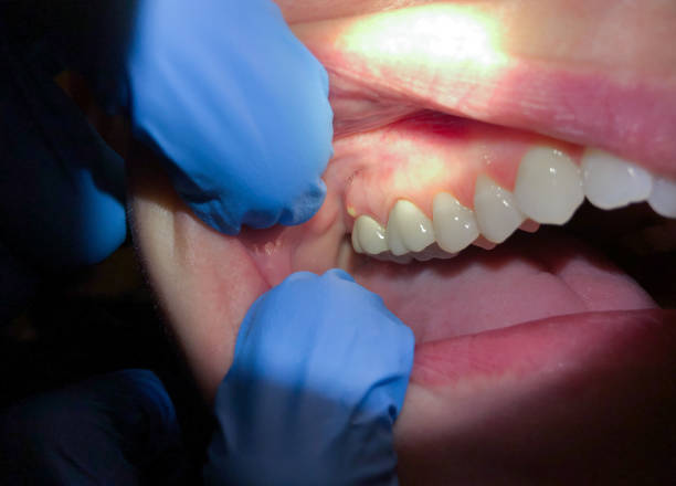 Best Emergency Tooth Extraction in Daphne, AL
